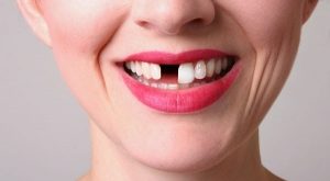 Top 10 địa chỉ trồng răng implant tốt nhất tại Tp HCM