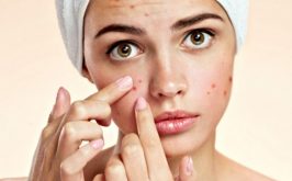 Top 5 Spa trị mụn hiệu quả nhất Thái Nguyên