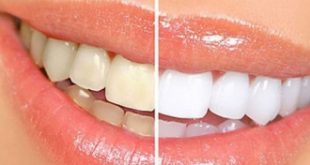Top 8 địa chỉ tẩy trắng răng hiệu quả, an toàn nhất tại Tp HCM