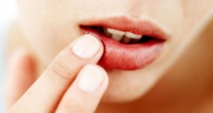 Top 9 Loại thuốc bôi nhiệt miệng hiệu quả nhất hiện nay