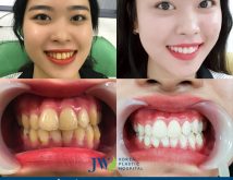 Top 9 Địa chỉ tẩy trắng răng uy tín chất lượng ở Đà Nẵng